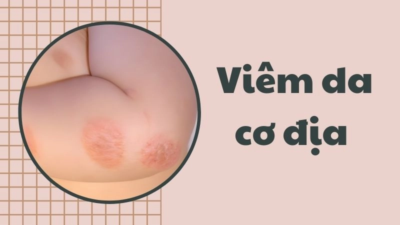Dấu hiệu nhận biết viêm da cơ địa phổ biến