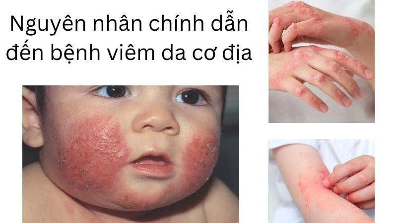 Nguyên nhân chính dẫn đến bệnh viêm da cơ địa